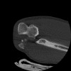 SPORK, NICO - 22.03.1976 - 02.08.2022 - CT obere Extremität - 17:51:17